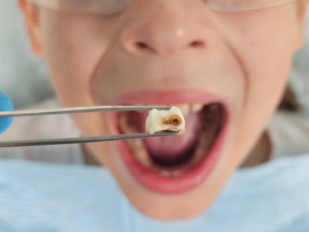 Best Emergency Wisdom Teeth Removal in Sprague, WV